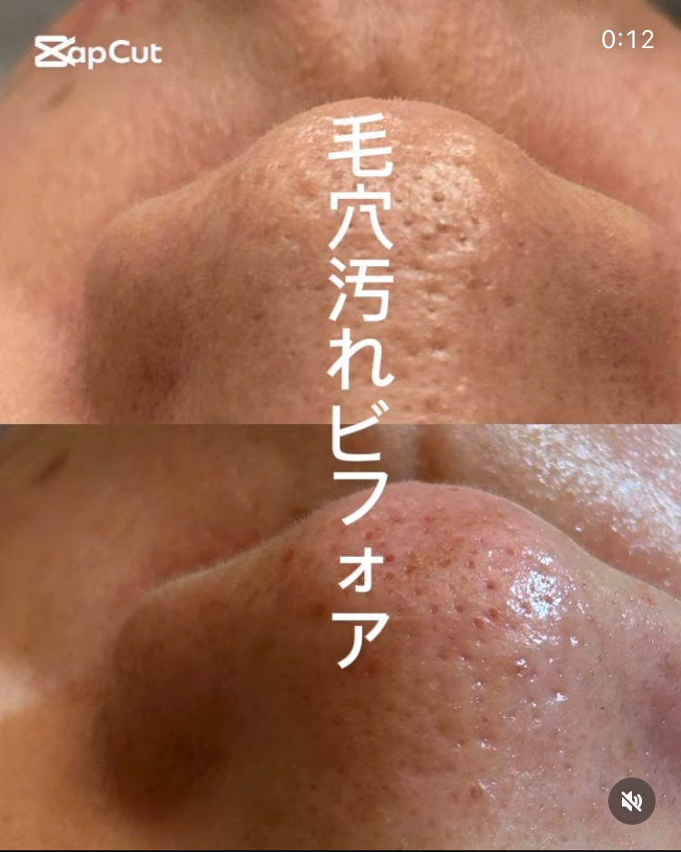 お鼻の毛穴before after😆